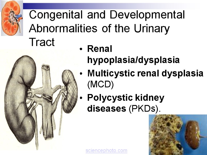 Congenital and Developmental Abnormalities of the Urinary Tract  Renal hypoplasia/dysplasia  Multicystic renal